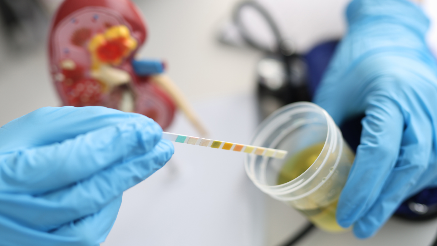 Diagnostika moču a pôvodcu infekcie. Zdroj foto: Canva Diagnostika moču a pôvodcu infekcie